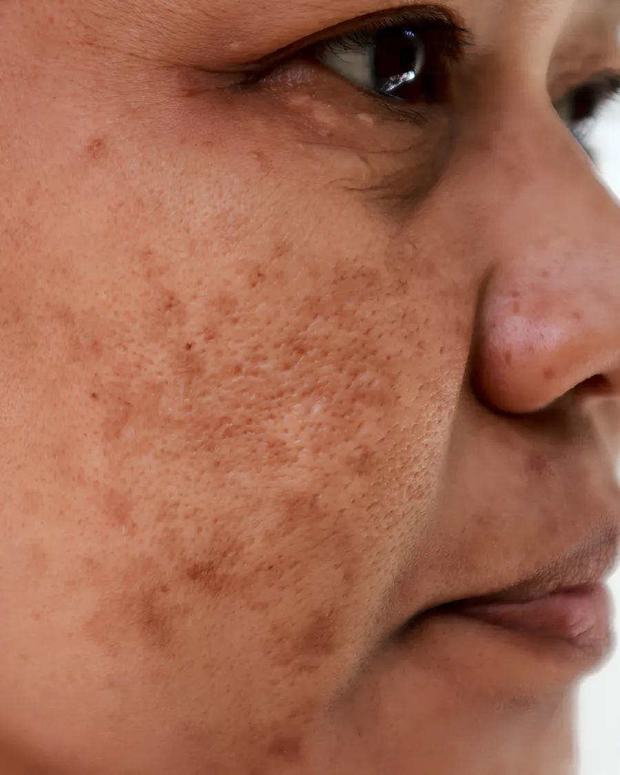 Advanced Melasma Care at Cinch Clinics